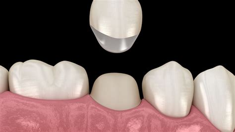 Do You Need Dental Crown After Root Canal Therapy Kirkland Premier