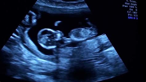 12 Weeks 5 Days Ultrasound Twins Youtube