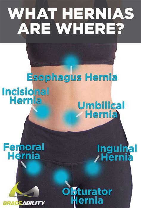Ventral Umbilical Spigelian And Epigastric Hernia Belt Support