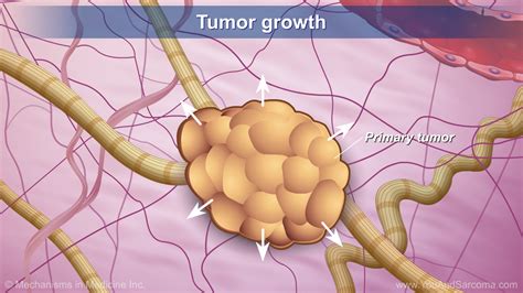 Understanding Soft Tissue Sarcoma