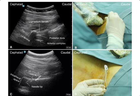 Real Time Ultrasound Guided Lumbar Puncture In A Sma Patient With