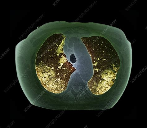 Asbestosis Ct Scan Stock Image C0132138 Science Photo Library
