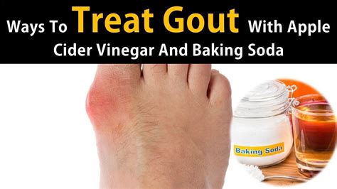 Ways To Treat Gout With Apple Cider Vinegar And Baking Soda Youtube
