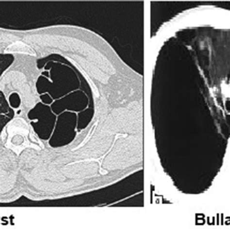 Bleb Cyst Bulla And Bullous Emphysema Download Scientific Diagram
