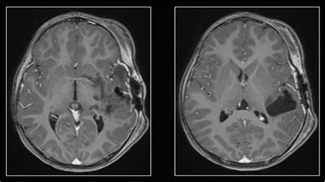 Postoperative Axial T1 Weighted Post Gadolinium Mri Scan Showing The