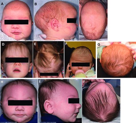 A C A Child With Sagittal Craniosynostosis Demonstrating