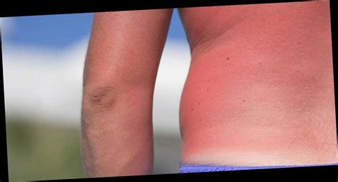 Here S How Long It Takes To Heal That Scorching Sunburn