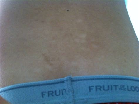 Skin Concern What Are Those White Spotdiscoloration On My Lower Back