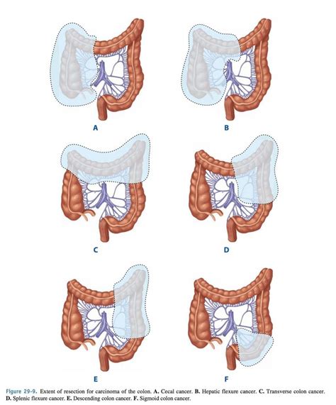 Extent Of Resection For Carcinoma Of The Colon Colon Cancer Colon