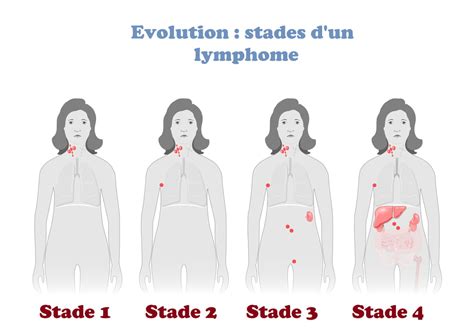 Top Symptoms Of Lymphoma Recognizing The Warning Signs Archyde