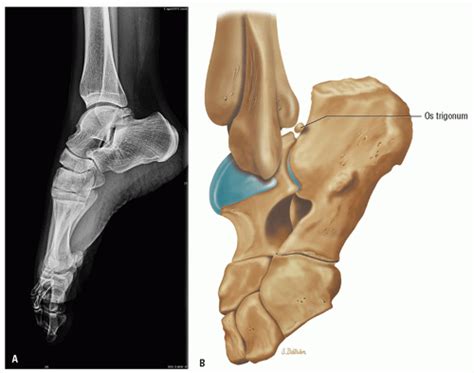 Subtalar Joint Pathology | Musculoskeletal Key