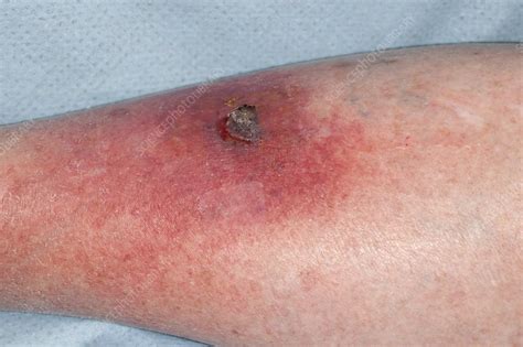Cellulitis Stock Image C0197717 Science Photo Library