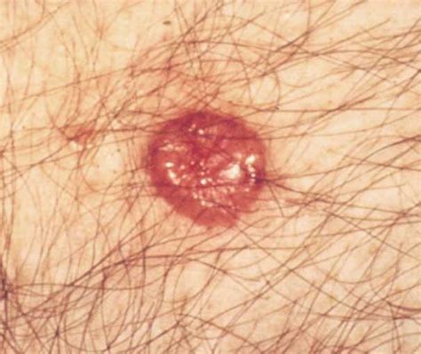 Basal Cell Carcinoma Long Beach Heller Dermatology And Aesthetic Surgery