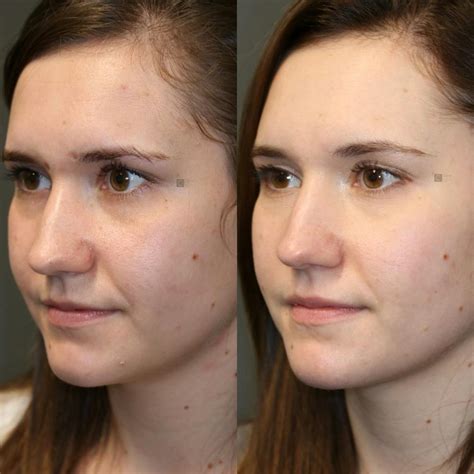 Patient 114700475 Scar Treatment Before And After Clinic 5c