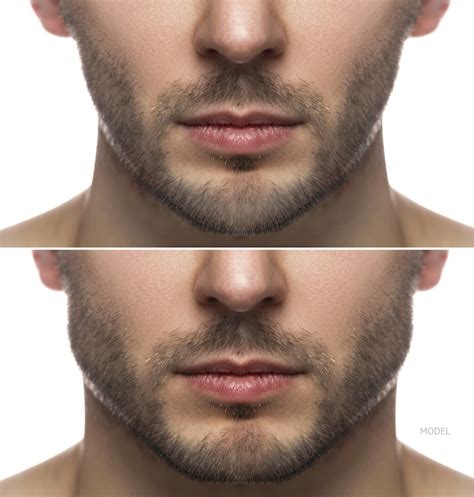 Will Jawline Contouring Increase Among Men In 2021 Beverly Hills Ca