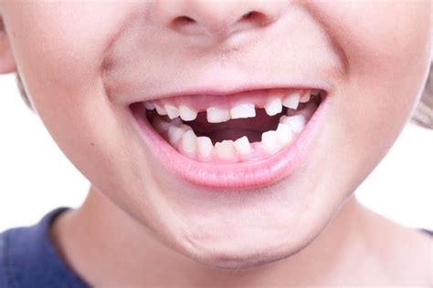 5 Behaviours That Can Result In Crooked Teeth Crooked Teeth Baby