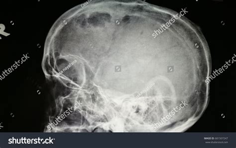 Metastatic Skull Lesion Presented Osteolytic Features Stock Photo