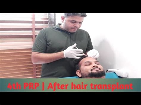 Prp After Hair Transplant Th Prp Result Youtube