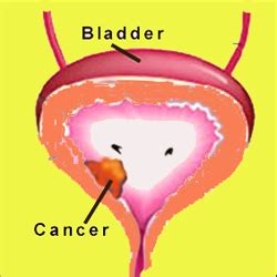 They may be caused by something other than bladder cancer, but it's important to have them checked out by a doctor. Total Cystectomy Surgery India,Cost Total Cystectomy ...