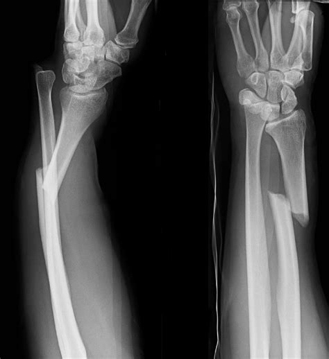 Galeazzi Fracture Dislocations