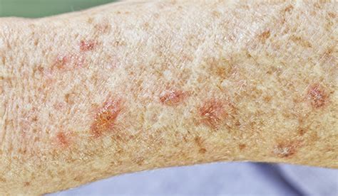 Actinic Keratosis Lesions And Skin Cancer What To Know