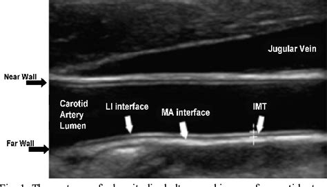Figure 1 From The Carotid Intimal Media Thickness Measurement Of Free