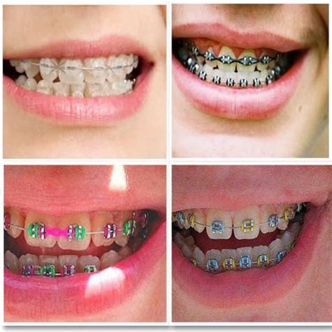 How To Make Fake Braces With Stuff At Home Retake Again