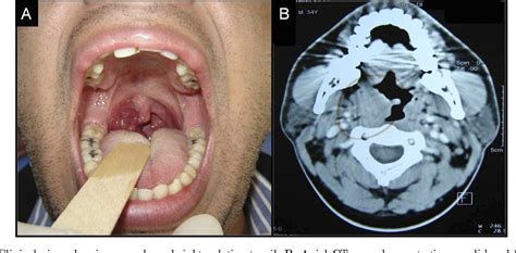 Figure 1 From Marginal Zone Lymphoma Of Mucosa Associated Lymphoid