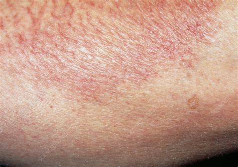 Close Up Of Patch Of Asteatotic Eczema On Skin Stock
