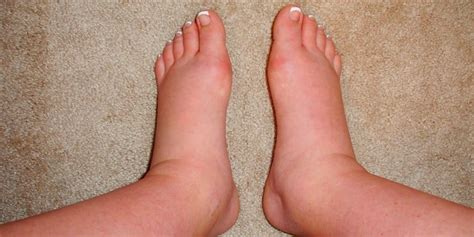 10 Obat Kaki Bengkak Alami agar Cepat Kempis • Deherba.com