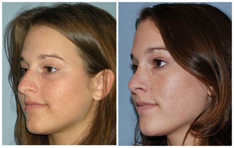 Atlanta Septoplasty And Rhinoplasty Before And After Photos