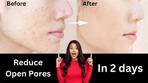 How To Get Rid Of Large Open Pores Permanently Enlarge Pores Shrink