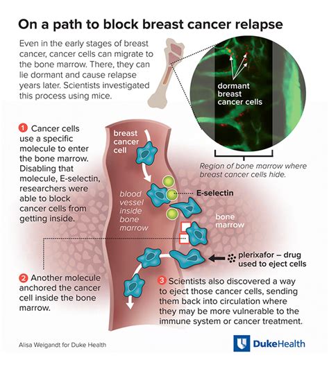 Stage iib iib of the breast cancer stages is used when the tumor is between 2 and 5 centimeters in size and it has spread to the lymph nodes, although only small clusters of cancerous. Cancer's Spread to Bone - National Cancer Institute