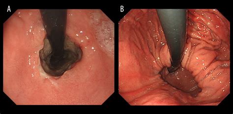 Paraesophageal Hernia Endoscopy