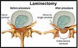 Lumbar Laminotomy Recovery Time