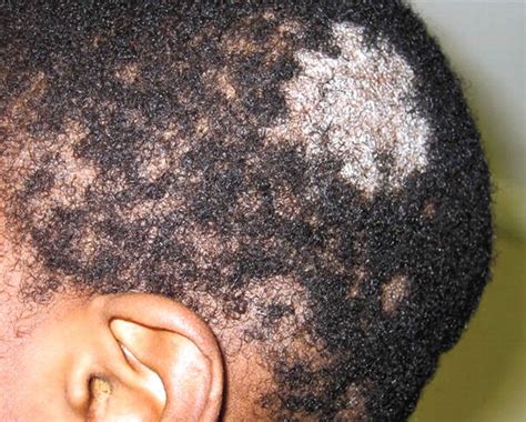The hair would normally regrow once the infection has been successfully cured. Tinea capitis scalp, causes, symptoms, diagnosis & tinea ...