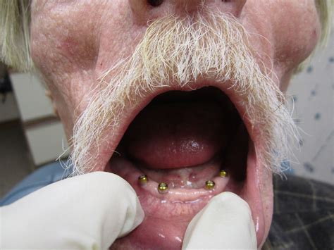 Patient presented to us to improve oral health. Dental Implant Pictures - Before and After - Portland ...