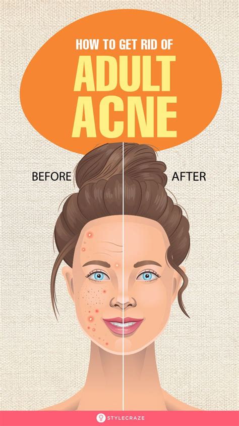 Adult Acne Causes Symptoms And Treatments Acne Causes Beauty