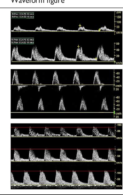 Interpretation Of Peripheral Arterial And Venous Doppler Waveforms A