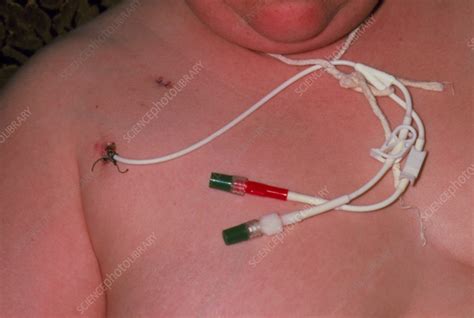 Close Up Female Patient With Hickman Catheter Stock Image M390