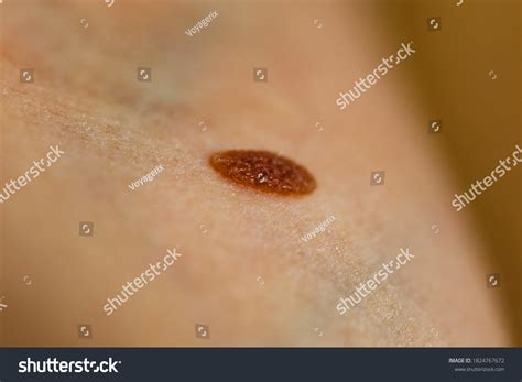 Skin Disease Closeup Brown Mole On Stock Photo 1824767672 Shutterstock