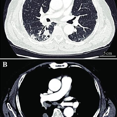 Chest Contrast Enhanced Computed Tomography Ct A The Lung Window
