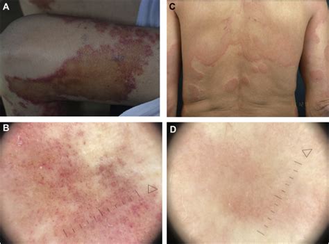 Urticarial Vasculitis Clinical And Laboratory Findings With A Particular Emphasis On