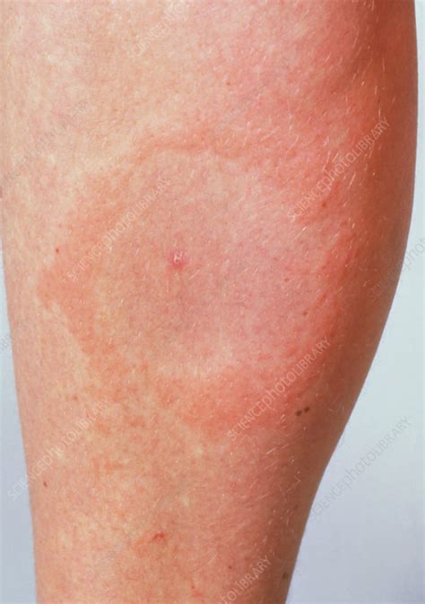 Lyme Disease Rash Stock Image M2000089 Science Photo Library