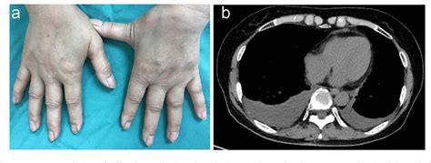 Figure 1 From Bilateral Pleural Effusion Associated With Remitting