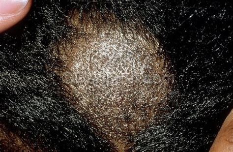 Scabs On Scalp Causes Treatment And Remedies Scalp Scabs Scalps