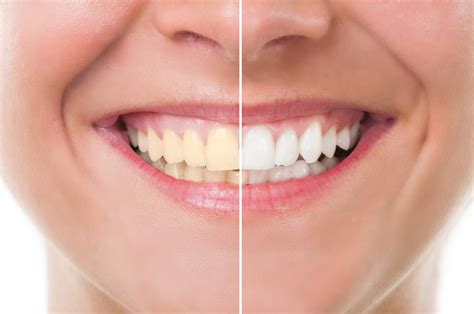 The Meaning Behind Discolored Teeth Dentist Cerritos