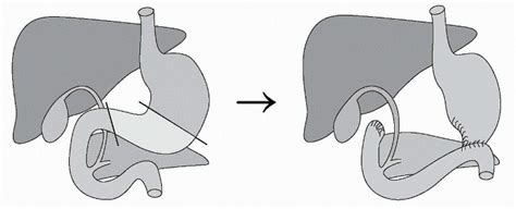 Gastrointestinal Surgeries Abdominal Key