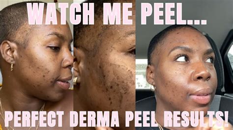 Chemical Peel Results The Perfect Derma Peel Before And After Results