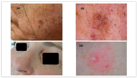 Jcm Free Full Text Dermoscopy Of Actinic Keratosis Is There A True